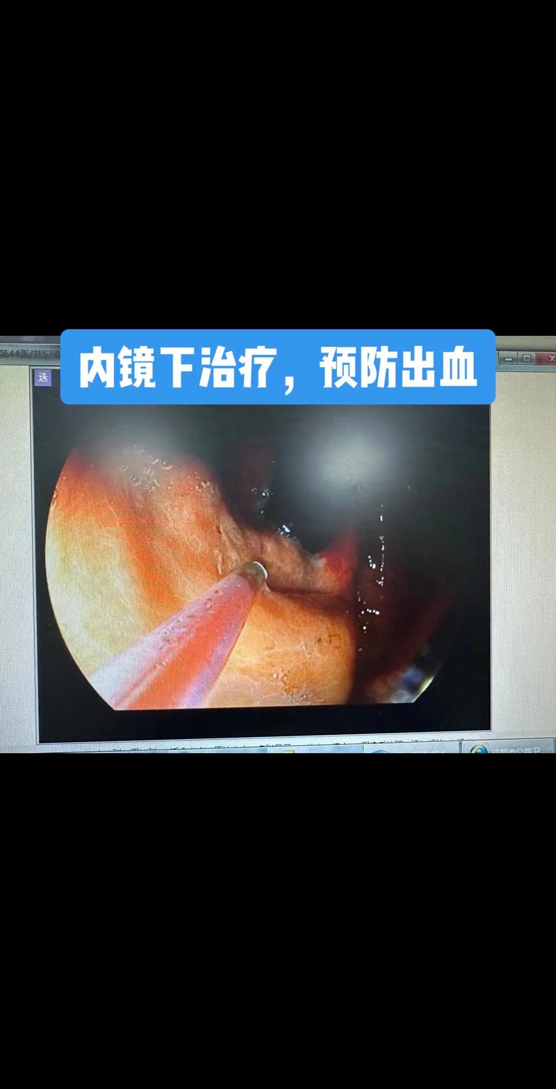 肝硬化與胃鏡檢查 守護消化道健康的關鍵一步